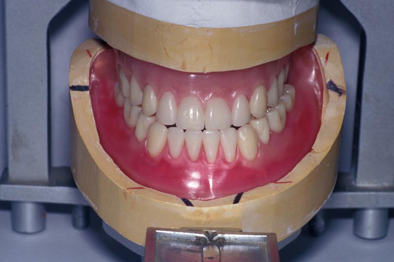 24 Rayspees wax trial dentures.jpg