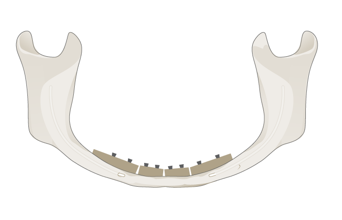 3066-grafting-mandible.png