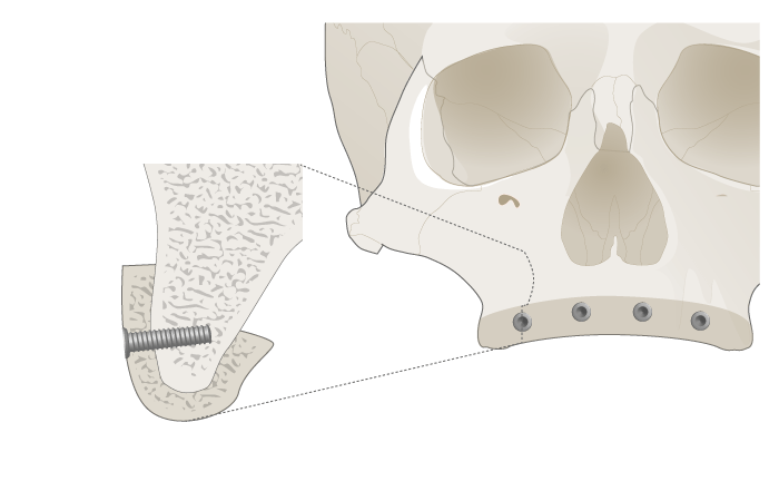 3067-grafting-upper-jaw-1.png