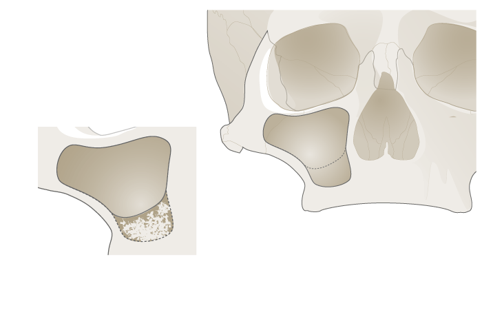 3067-grafting-upper-jaw-2.png