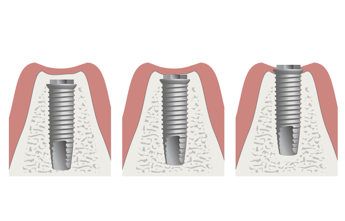 3420-Placement-of-implant-height.png