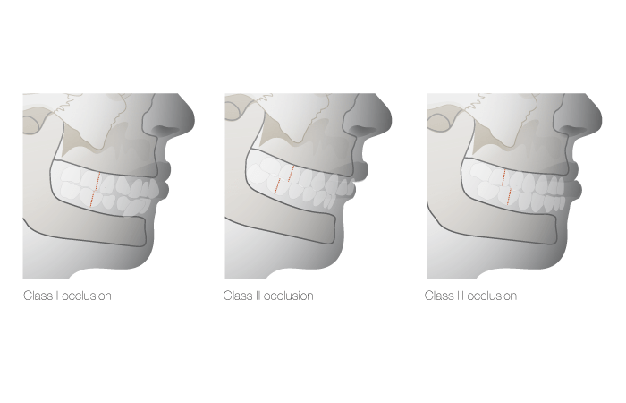 C1210-Malocclusion-types.png