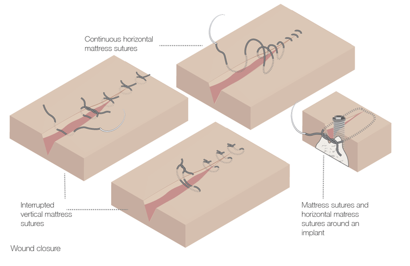 C3058_wound closure.png