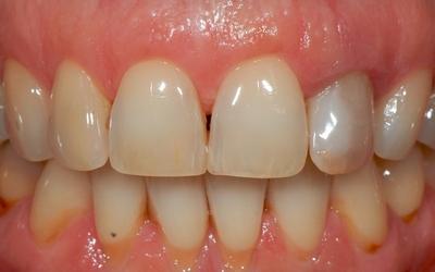 Intra-oral frontal photograph. Note the discoloration of tooth #22 (FDI) / #10 (US).
