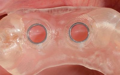 Intra-oral occlusal view of the upper right side. Surgical guide with the two holes to mark where the two implants will be placed. 