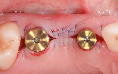 Intra-oral occlusal view of healing cap and stitches.