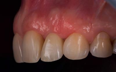 Intra-oral photograph 3 years post-treatment. Tissues around the implant were stable.