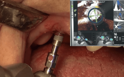 implant placement dtx