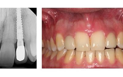 5 years clinical study narrow implants