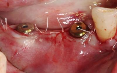 Implants in situ following GBR Clinical Research Aleksic 2021