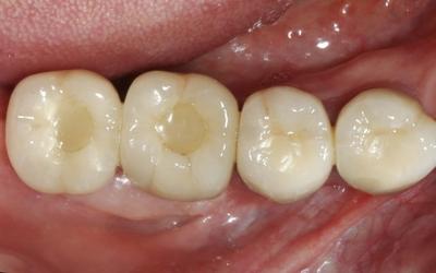 Intra-oral occlusal photograph after one year post-treatment.