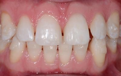 The upper anterior teeth were provisionally widened with composite resin restorations. This simplified the orthodontic treatment, as the treatment goal shifted from an even distribution of spaces, which is challenging to achieve, to a narrower closure of open spaces. 
