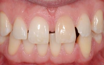 Initial intraoral frontal view.  Note the presence of a wide diastema between the upper central incisors and the discoloration of the upper left central incisor.