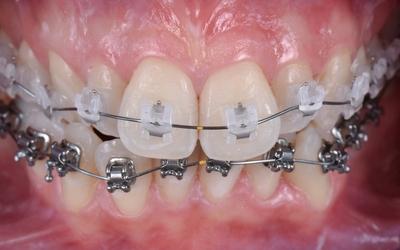 Frontal intra-oral view of fixed orthodontic buccal braces.
