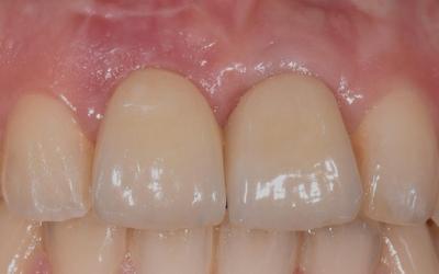 Intraoral follow up of the crowns over implant. 
