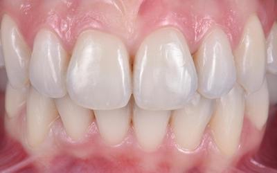 Frontal intra-oral view after the orthodontic treatment was completed and the final implant restorations were fitted.
