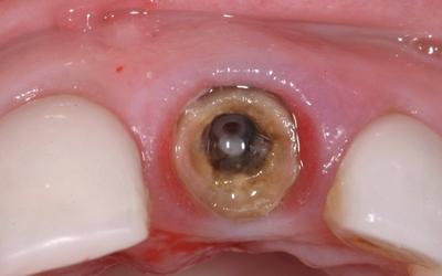 Occlusal view of remaining root structure of tooth #21 FDI (#9 US) showing extensive caries.