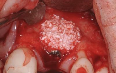 Anorganic bovine bone graft placed to replace missing bone volume. 