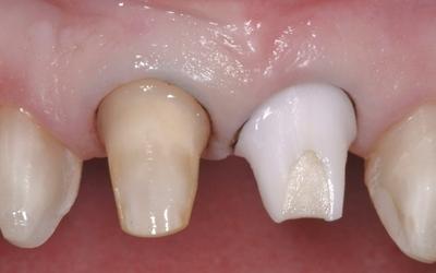 Upper crown cementation with retraction cord.