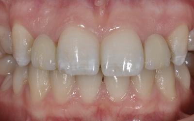 Frontal view of the resin-bonded fixed partial denture used as a provisional solution from 15-19 years age. 