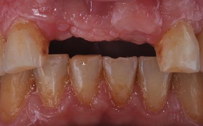 Intraoral view of initial situation. Tooth loss #11 and #21 FDI (#8 and #9 US) due to a car accident.