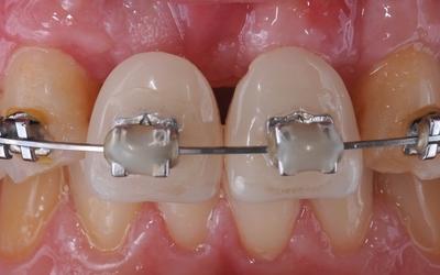 Orthodontic treatment was used to provide proper spacing for the two provisional pontics. 