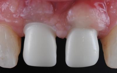 The cervical contour of the zirconia implant crown on tooth #11 FDI (#8 US) needs to be corrected so the finish line is located subgingivally due to a visible supra-gingival position.