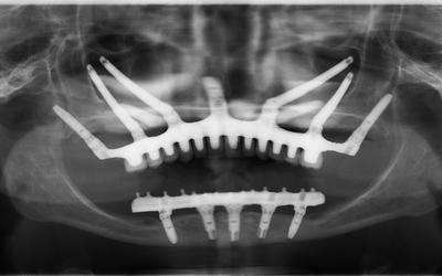 Post-OP x-ray