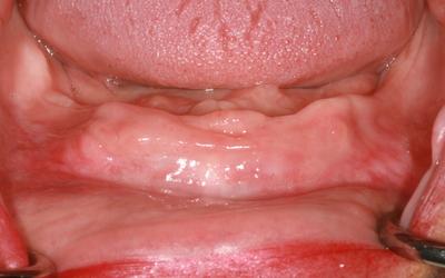 Initial situation - mandible: severely resorbed ridge