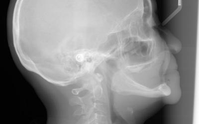 Initial lateral cephalometric film