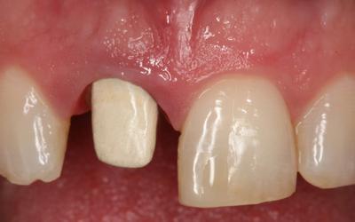 Cementation of metal-ceramic alloy post with opaque porcelain.