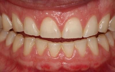 Pre-treatment image showing abraded teeth.