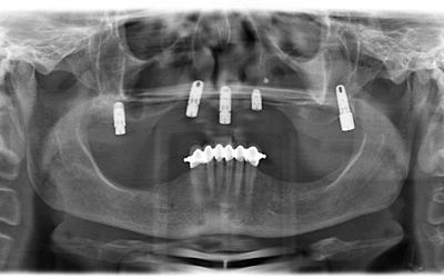 Initial panoramic radiograph.