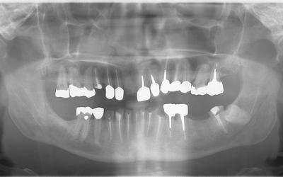 Initial panoramic radiograph - teeth are not restorable due to bone loss, wear and caries.