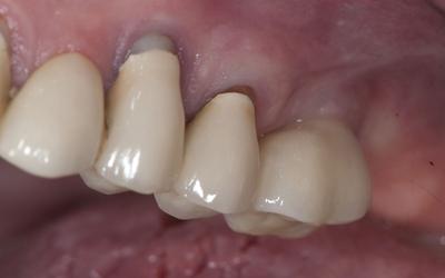 Definitive crown on tooth #26 (#14 US).