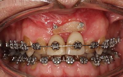 Anterior dehiscense of chin graft – first evaluation.