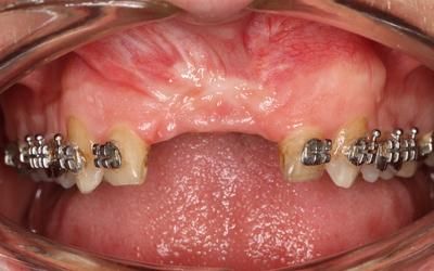 Initial situation - maxillary central incisors are missing.