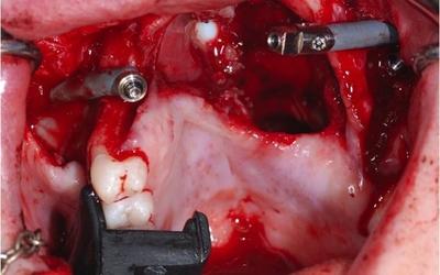 Surgery - implant placement.