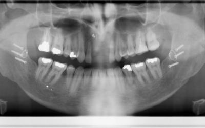 Initial panoramic radiograph.