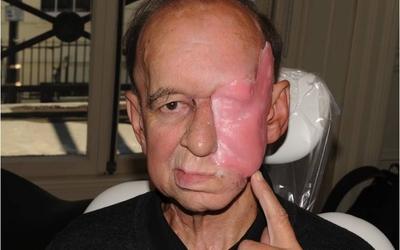 Wax-up of facial prosthesis