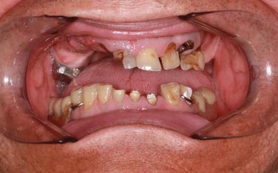 Initial situation showing failing dentition.