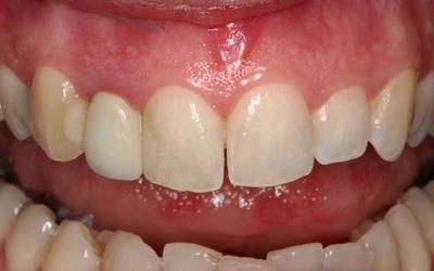 Initial situation with less than optimal periodontal health around the lateral incisor crown.