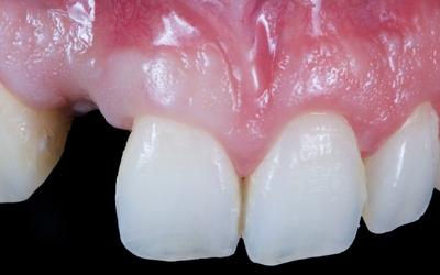 The patient presented with a missing upper lateral incisor. The hard and soft tissues had collapsed vertically and horizontally and needed to be reconstructed for improved aesthetic treatment results.