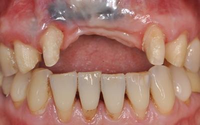 Frontal view after removal of the provisional in occlusion is showing an open bite.