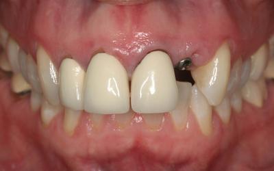 Condition after periodontal treatment (oral hygiene instructions, scaling and root planing), extraction and immediate implant placement.