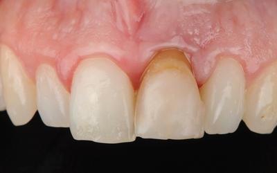 牙齿 #21 (FDI)/#9（美国）的初期情况：牙龈粘膜边缘向顶端移动