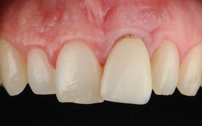放置贴面 3 个月后，由于牙根继续萎缩，牙龈边缘继续向顶端移动。为了避免其他并发症，必须拔除该牙齿。