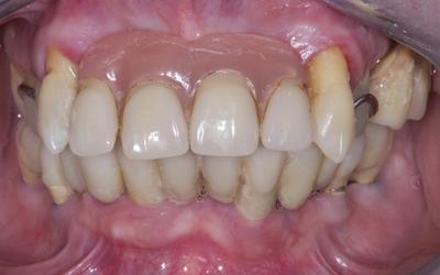 Intraoral view of the initial situation: poor design of the upper prosthesis and elongated canines.