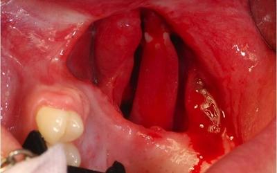 Intraoral view, initial situation. Please note the oro-nasal communication.