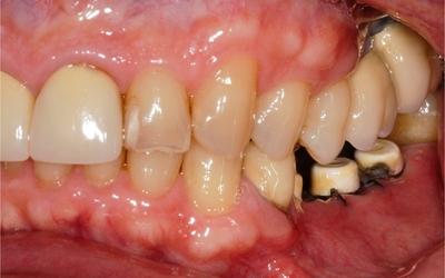 Initial left quadrant - recently malpositioned implants, sutures still in place.